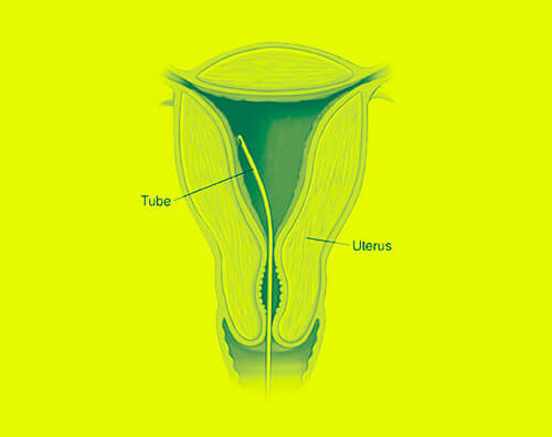 Endometrial scratch